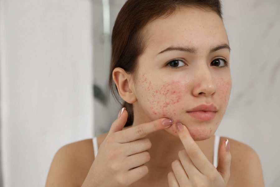 Dermocosméticos e Acne: Tratamentos Eficazes para uma Pele Saudável